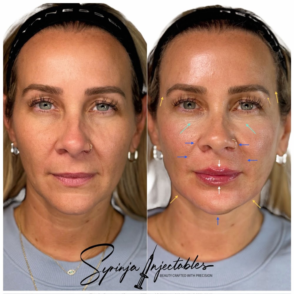 Syrinja Injectables